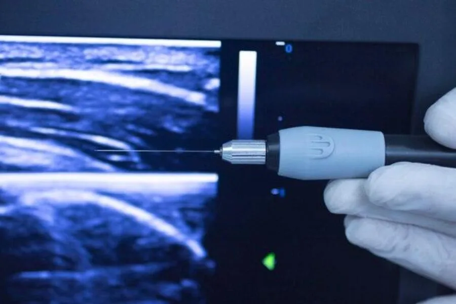 Endometrioza a ciąża – jak wpływa na płodność i jakie są opcje leczenia?